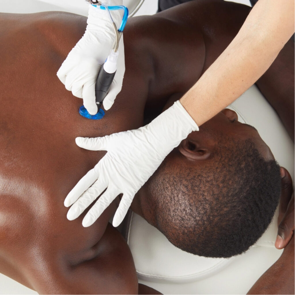 hydrafacial-back-facial-treatment-for-back-acne