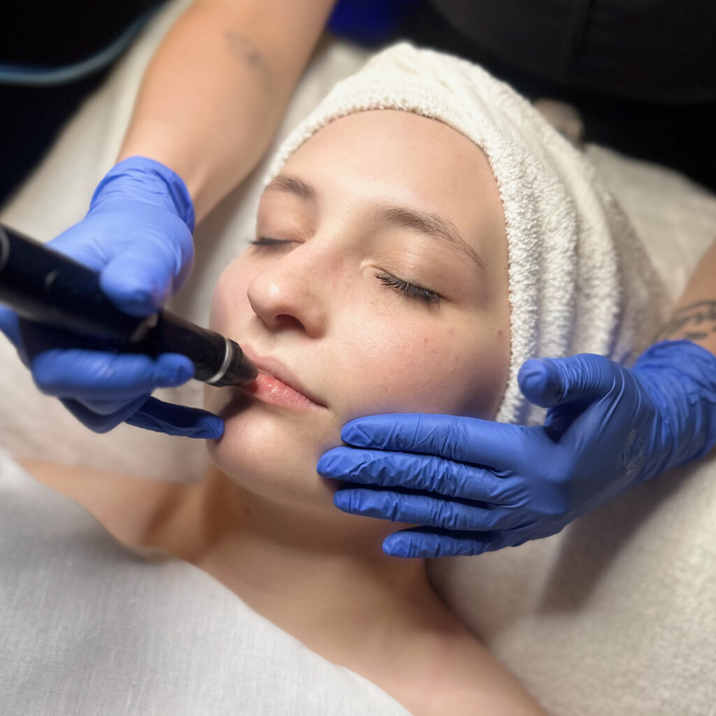 hydrafacial-lip-perk