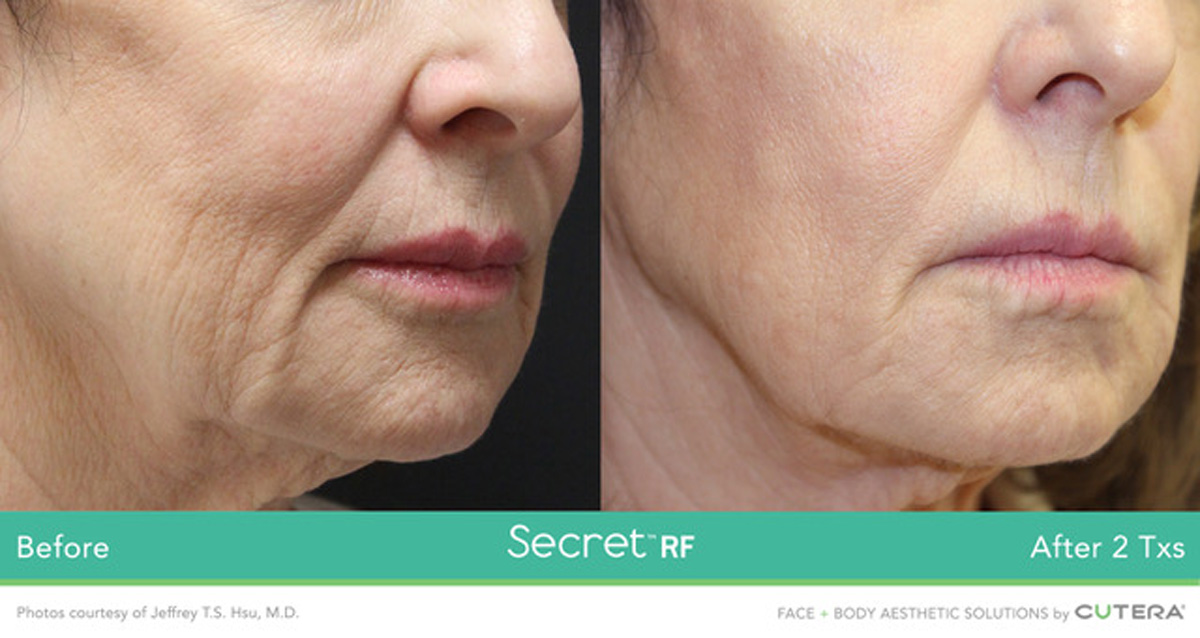 secret-rf-microneedling-skin-resurfacing-for-fine-lines-wrinkles-and-acne-birmingham-michigan-rivage-day-spa-before-after1
