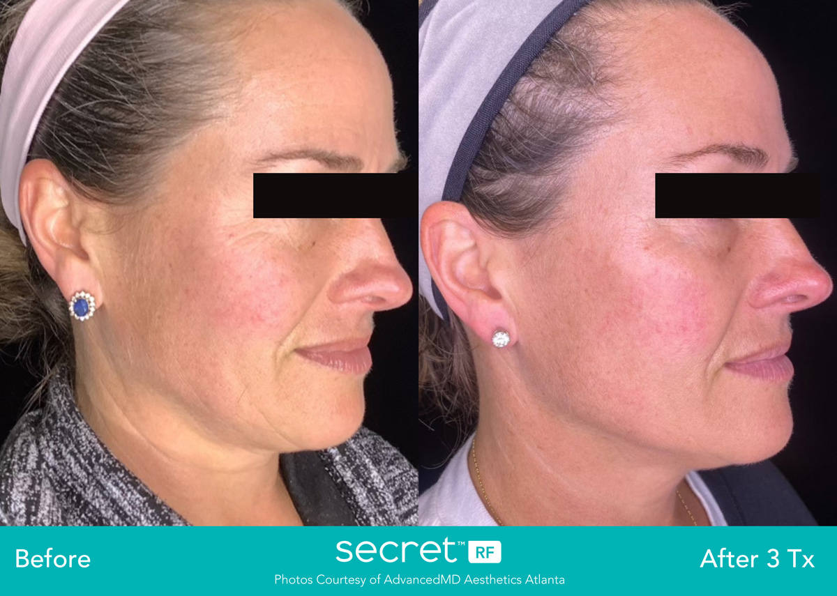secret-rf-microneedling-skin-resurfacing-for-fine-lines-wrinkles-and-acne-birmingham-michigan-rivage-day-spa-before-after2