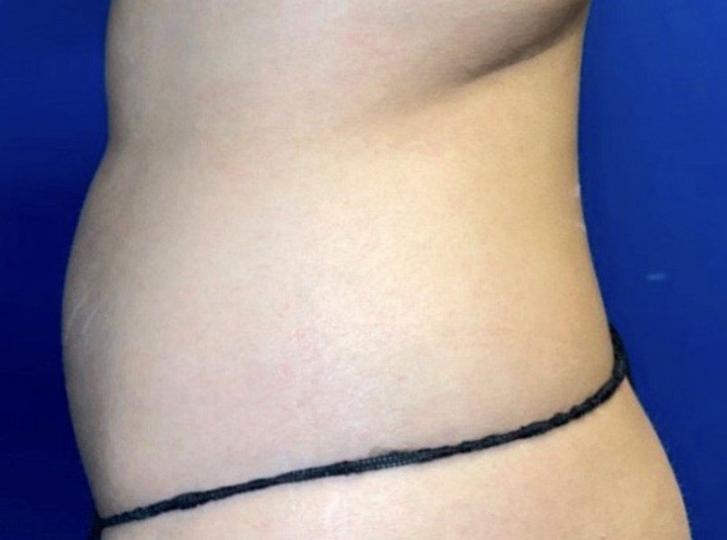 After NuERA Tight body treatment