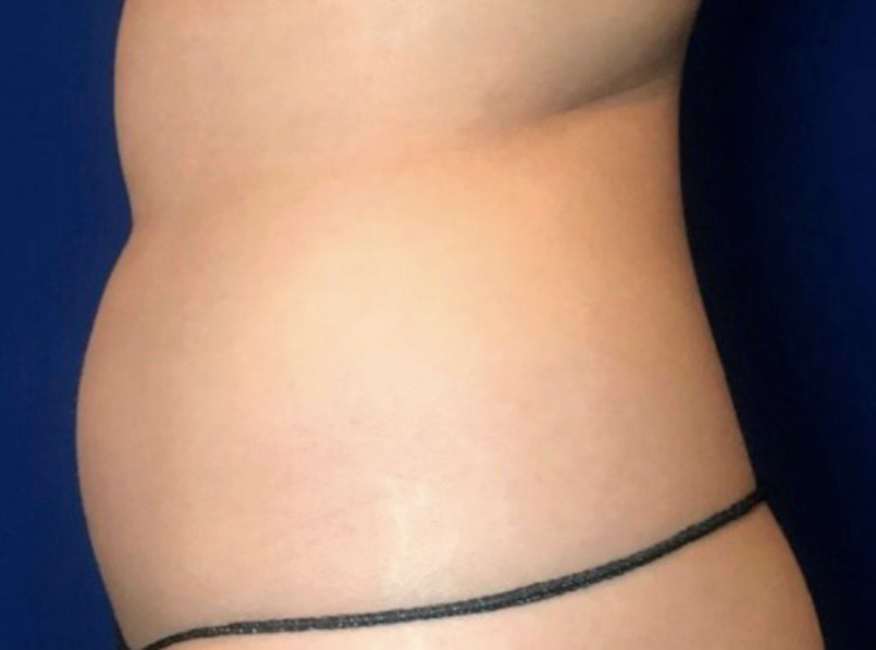 Before NuERA Tight body treatment