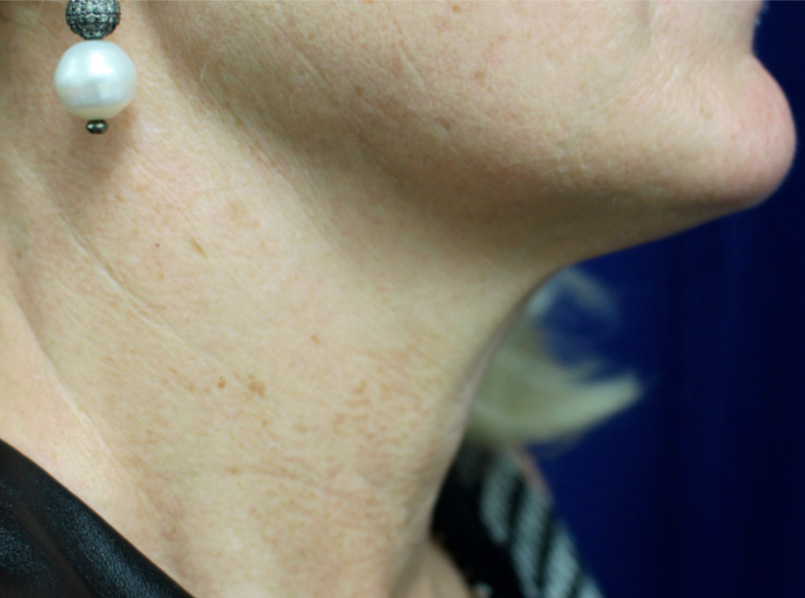 After NuERA Tight jawline and neck treatment