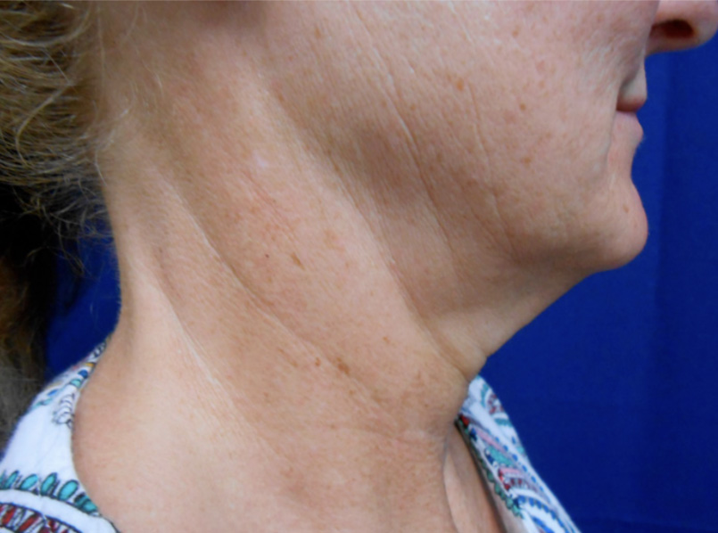Before NuERA Tight jawline and neck treatment