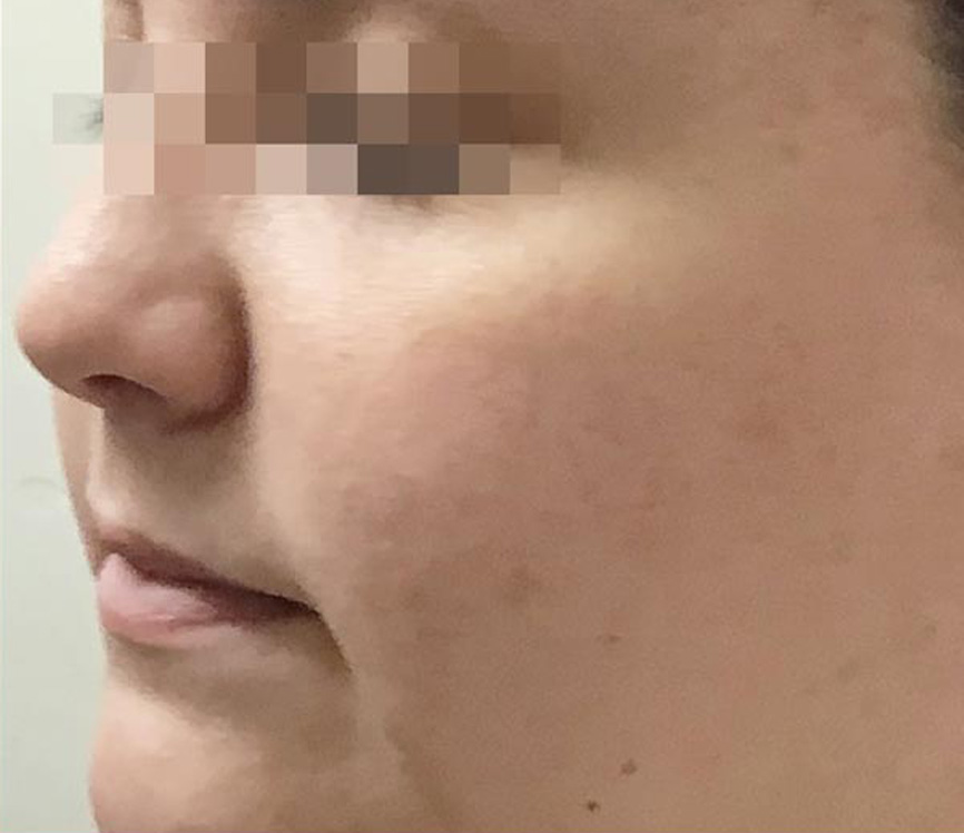 Secret RF microneedling before and after results — Rivage Day Spa, Birmingham MI