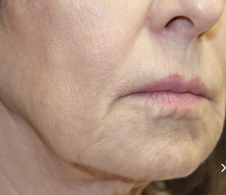 Secret RF microneedling before and after results — Rivage Day Spa, Birmingham MI