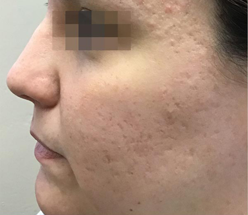 Secret RF microneedling before and after results — Rivage Day Spa, Birmingham MI