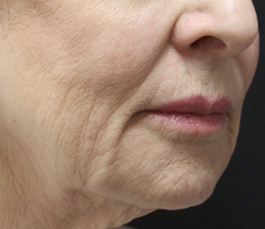 Secret RF microneedling before and after results — Rivage Day Spa, Birmingham MI